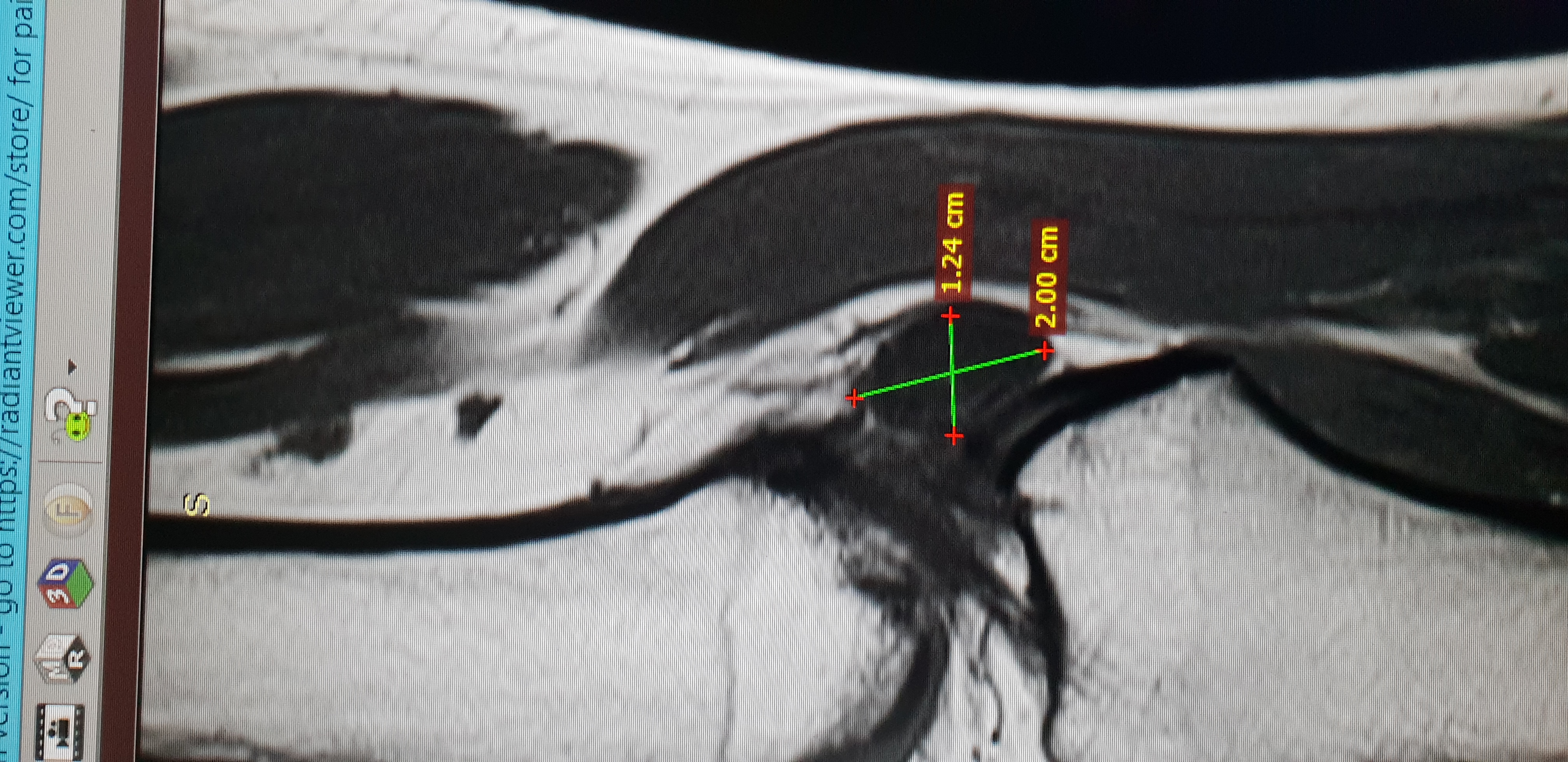 Pre-operative MRI scan of knee
