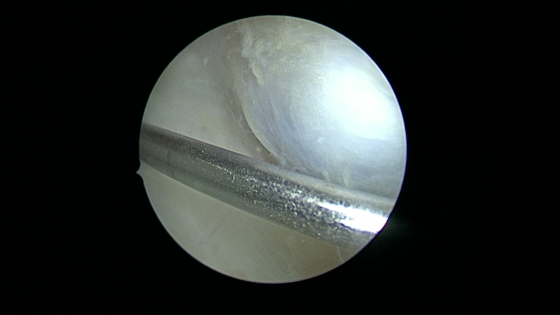 Arthroscopic view — osteochondral lesion