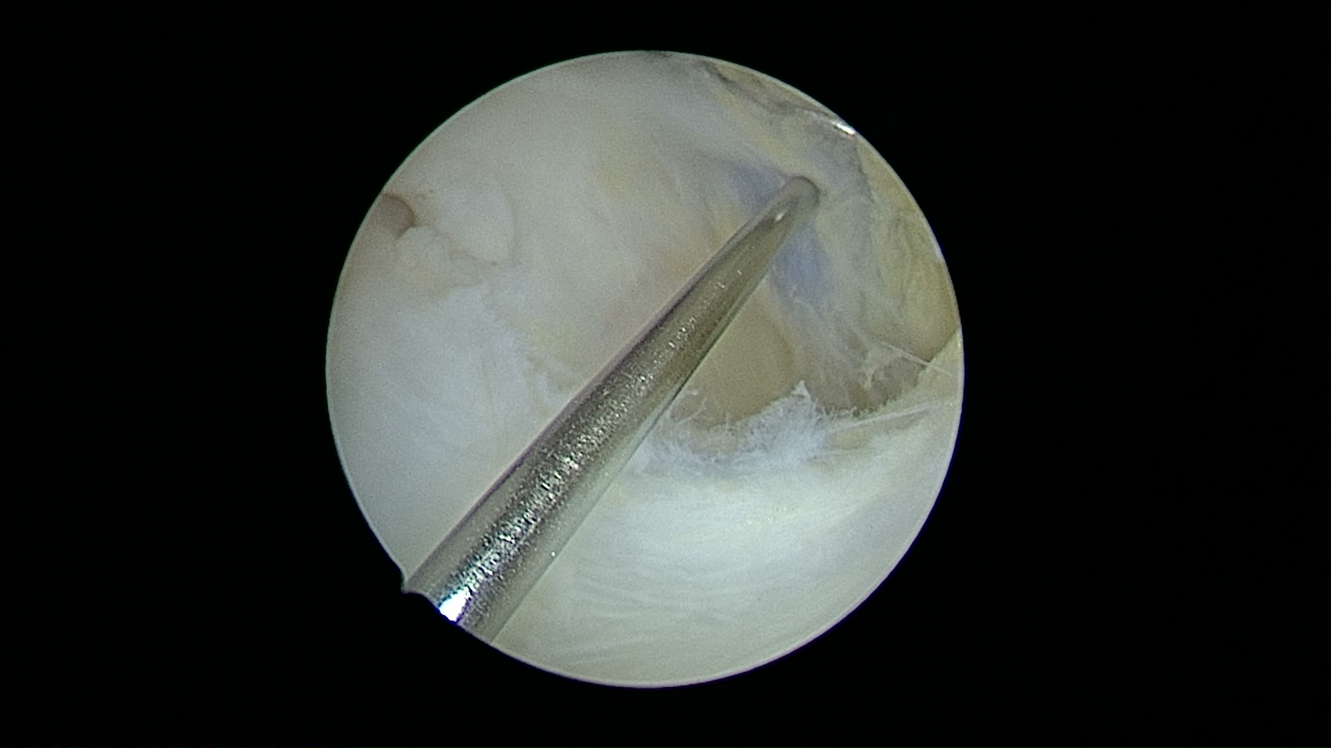 Arthroscopic probe assessing lesion