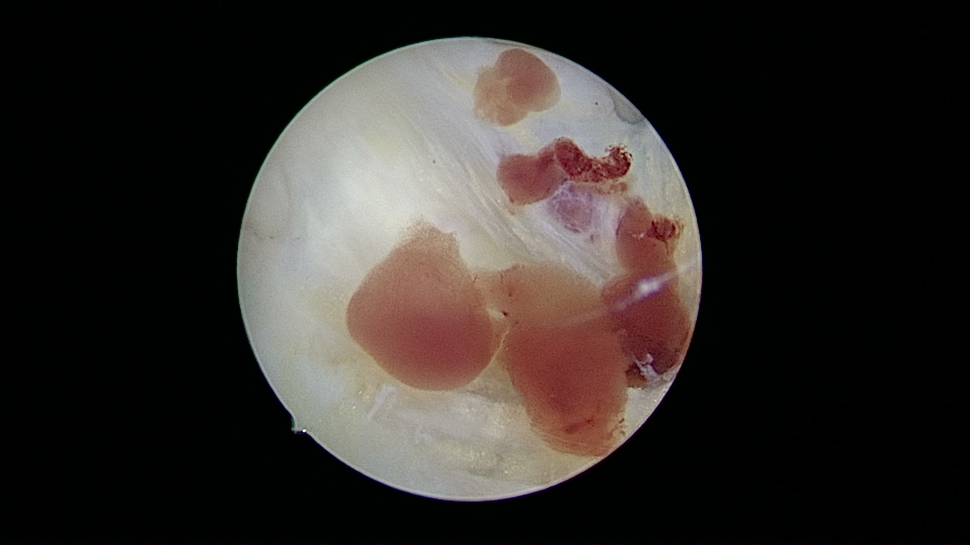 Arthroscopic view — cartilage defect surface
